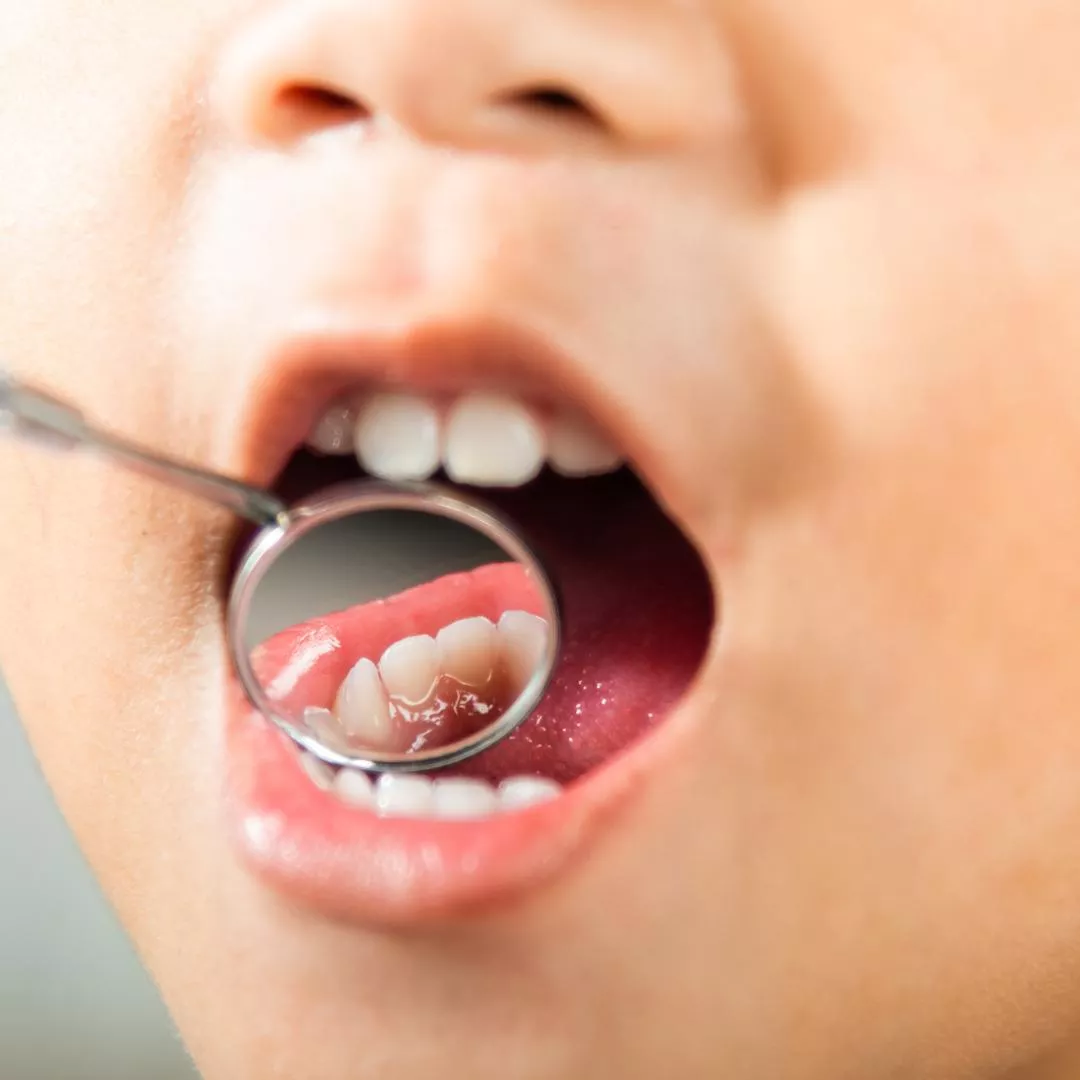 Cavities