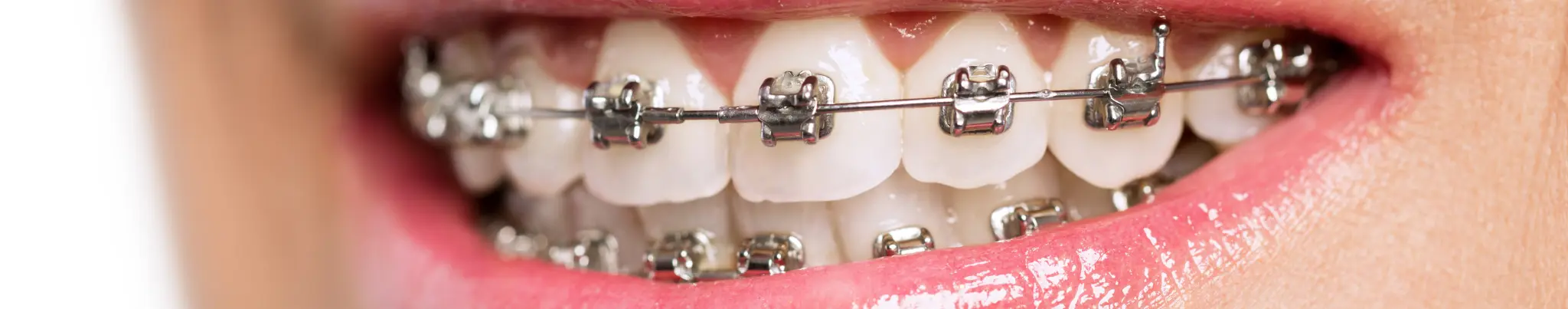 adult braces