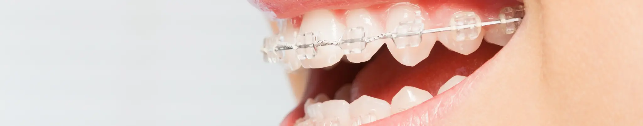 adult braces