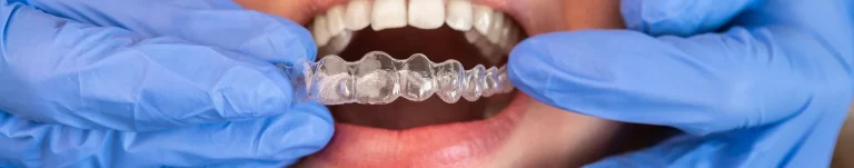 Invisalign