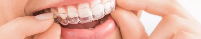 Invisalign