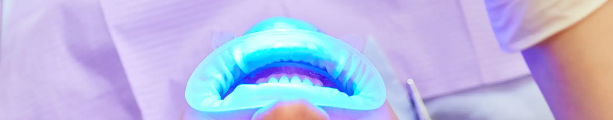 professional teeth whitening 