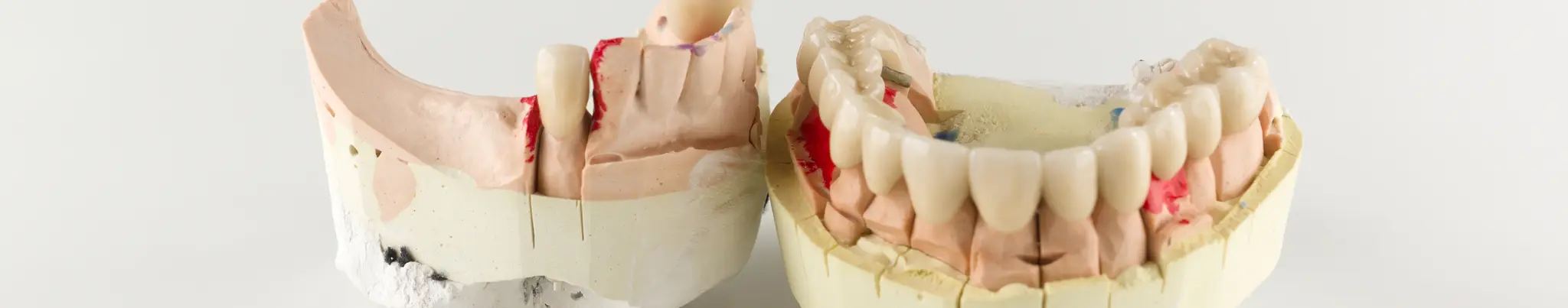 root canal